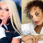 Pabllo Vittar choca fãs ao aparecer com rosto inchado e cheio de curativos